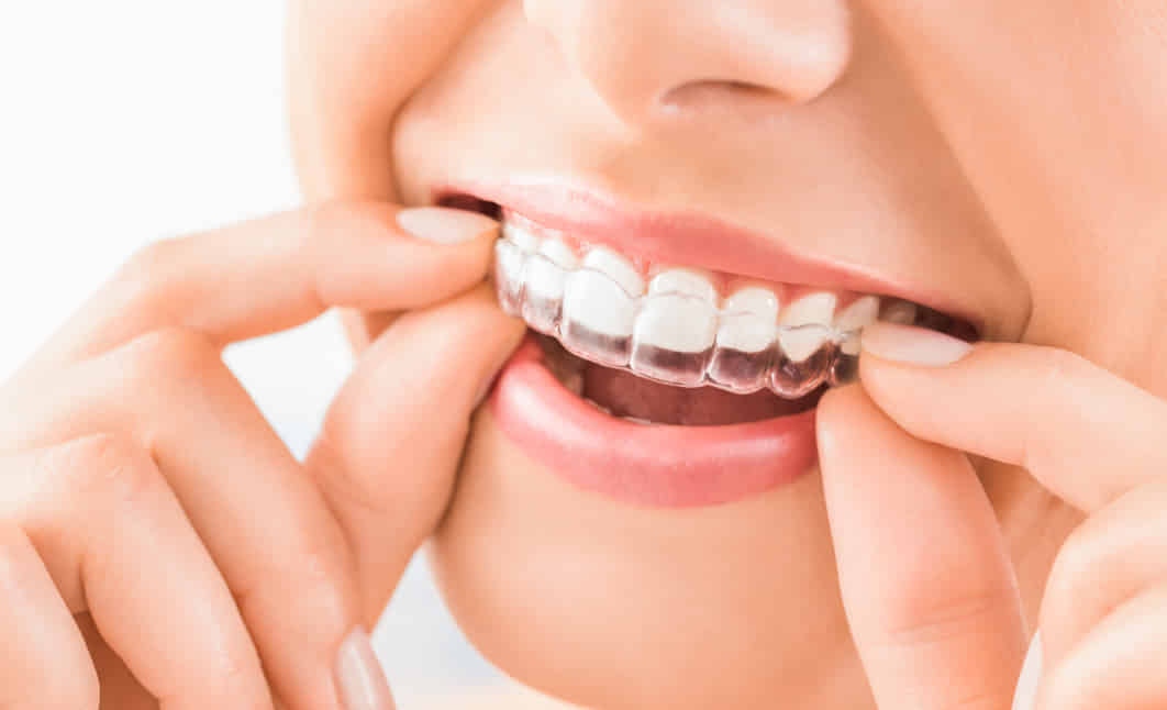 Invisalign treatment