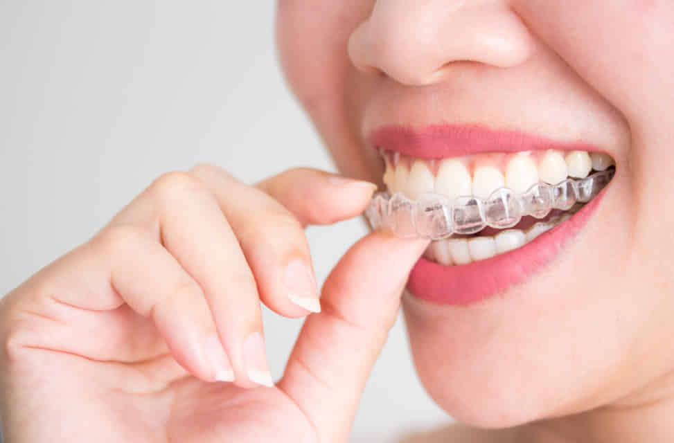 Invisalign treatment