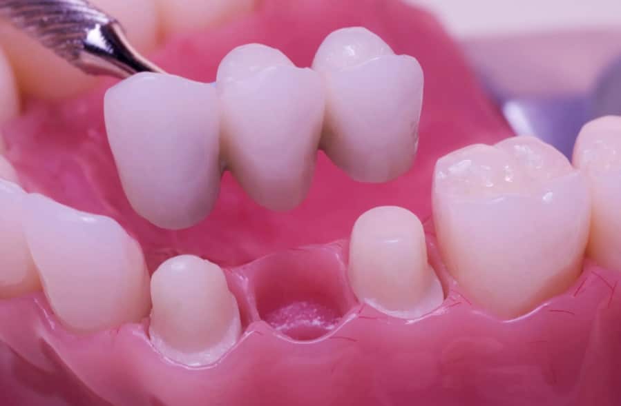 dental implants in Greensboro