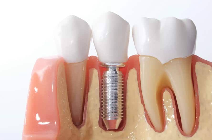 dental implants in Greensboro