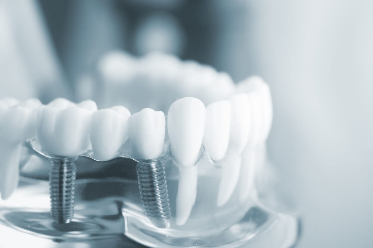Ottawa Dental implants