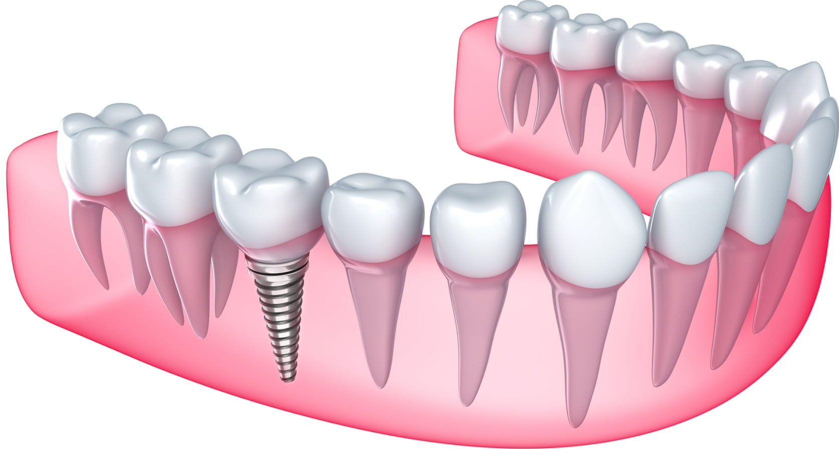 Ottawa Dental implants