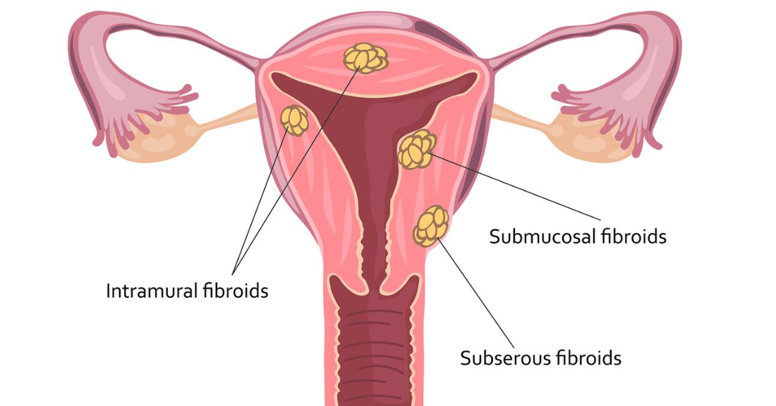 fibroid