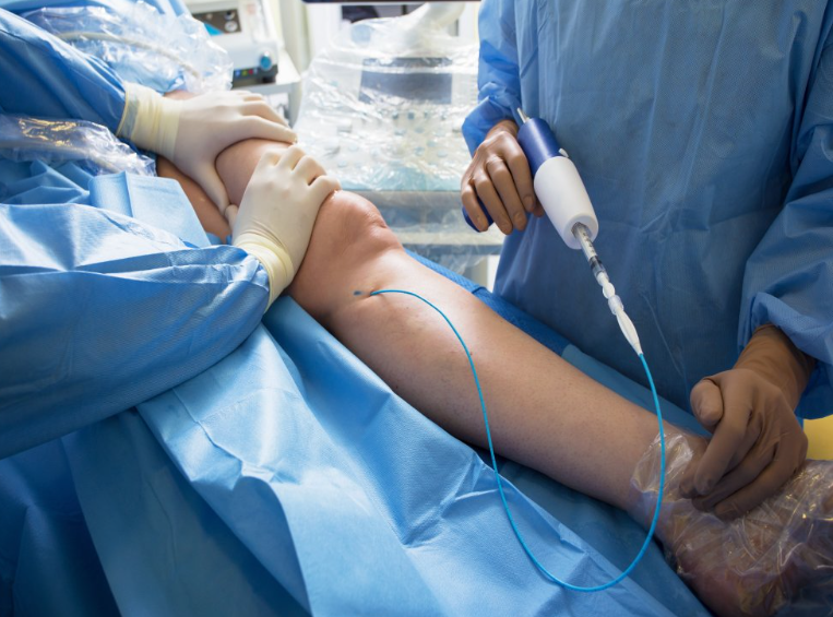 spider vein removal in Sydney