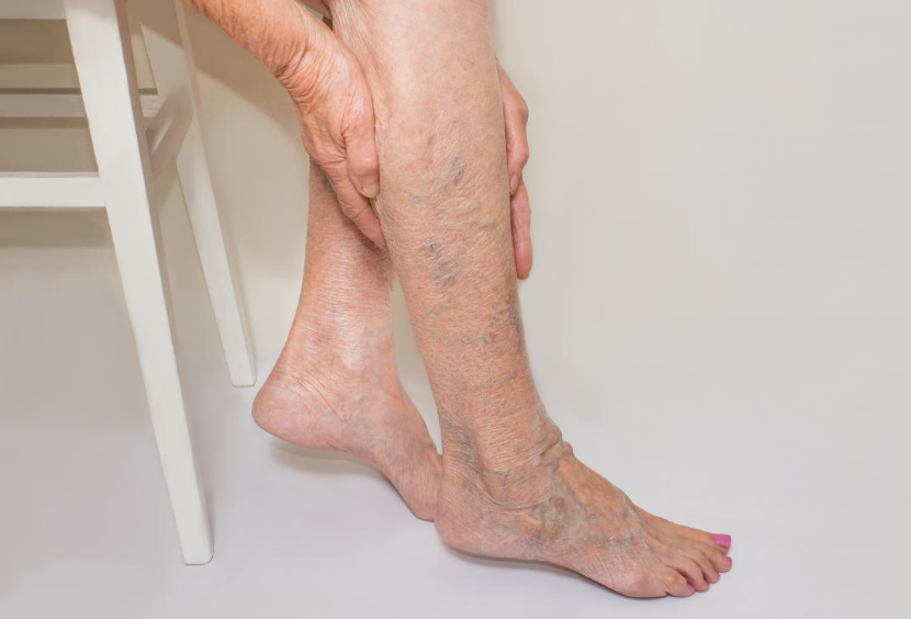 spider vein removal in Sydney