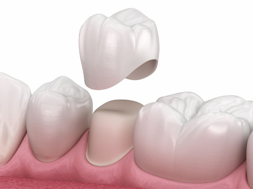 same-day dental crowns