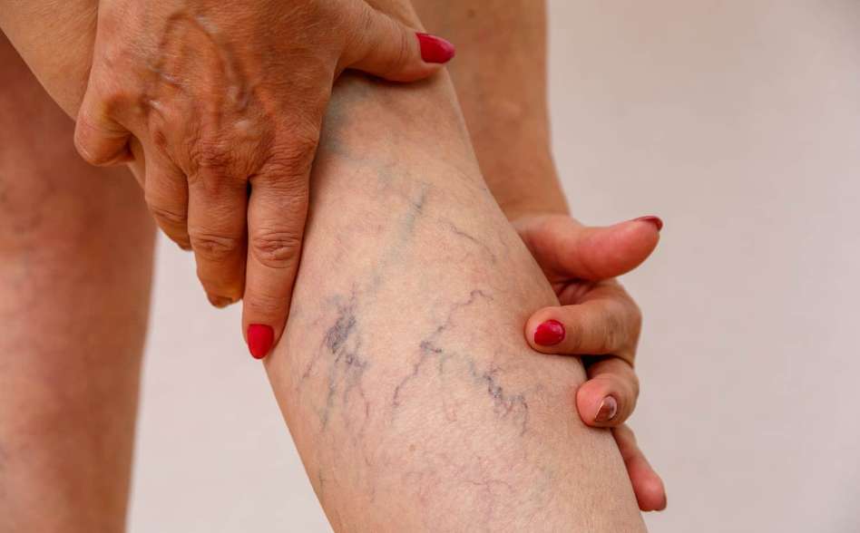 Sclerotherapy interventional radiology