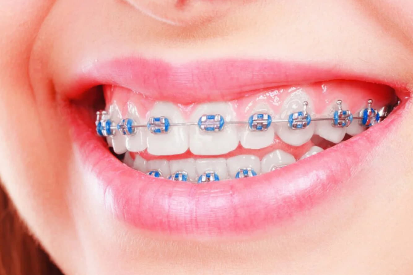 braces in Duncan