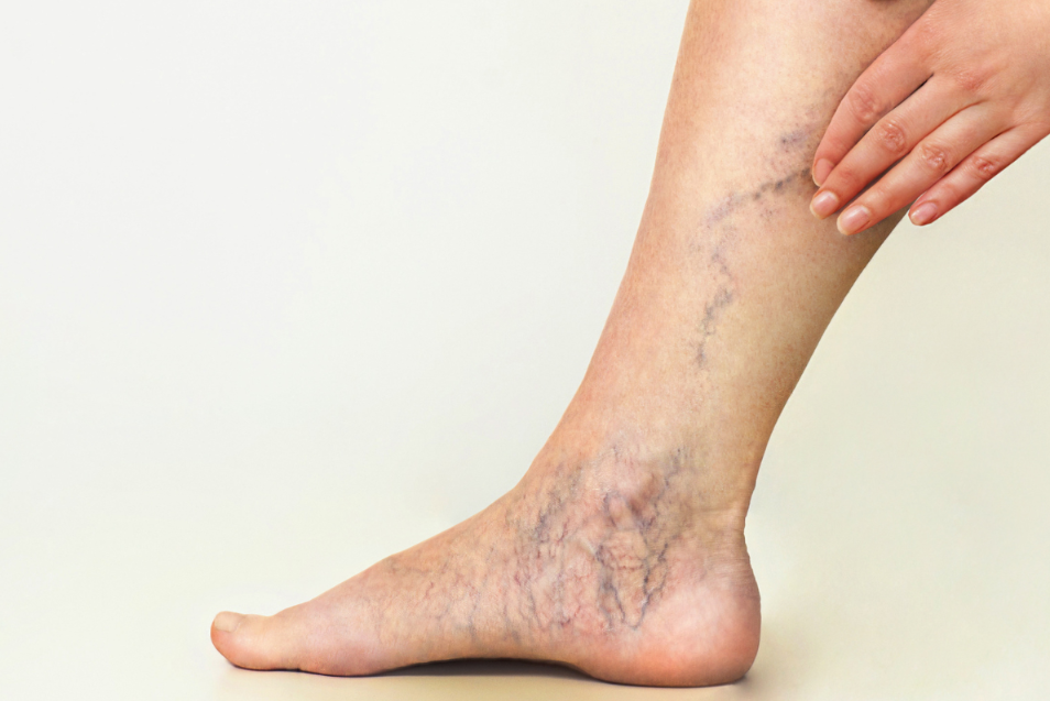 spider veins in Sydney