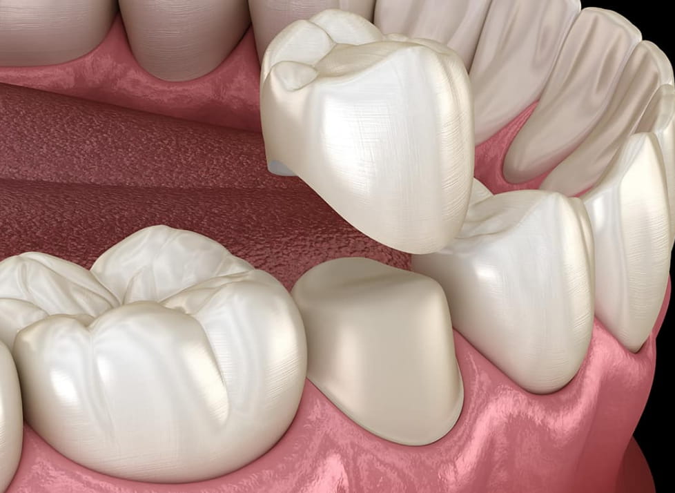 dental crowns