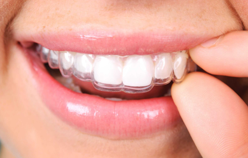 Invisalign treatment