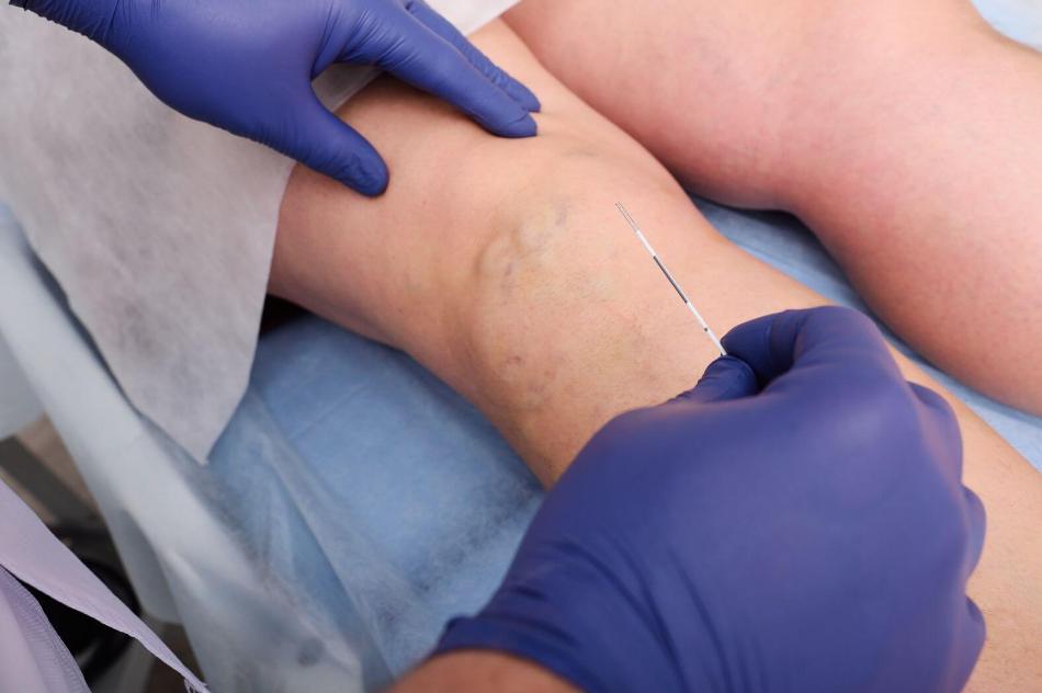 vein injections for varicose veins