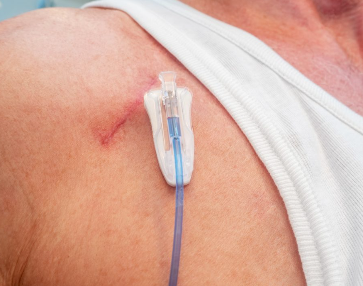 Port a cath chemotherapy