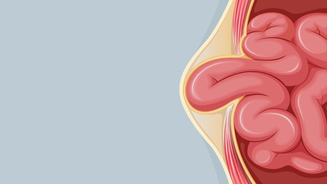 hernia removal surgery on the Gold Coast