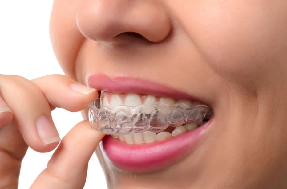 Invisalign treatment in Victoria